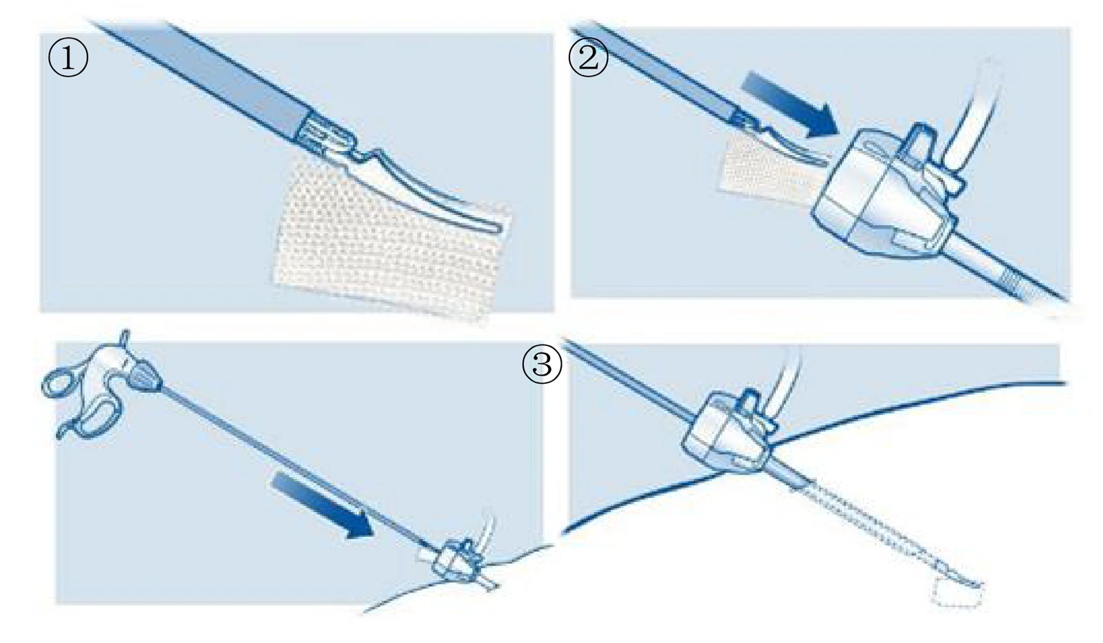 oxidized-cellulose-dressing oxidized-cellulose-dressing